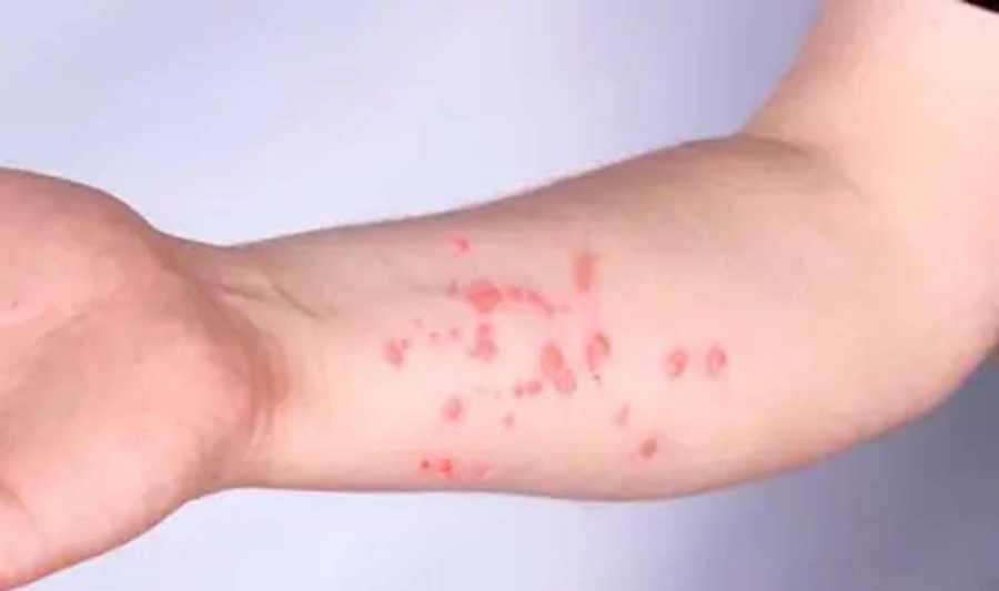 Brasil registra 140 casos de mpox em 2026